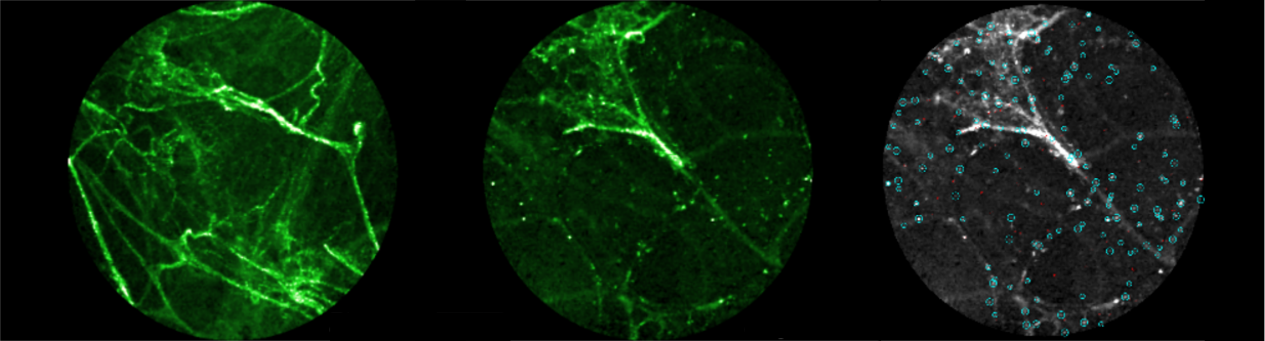 Images of lung tissue of a patient with bronchiectasis